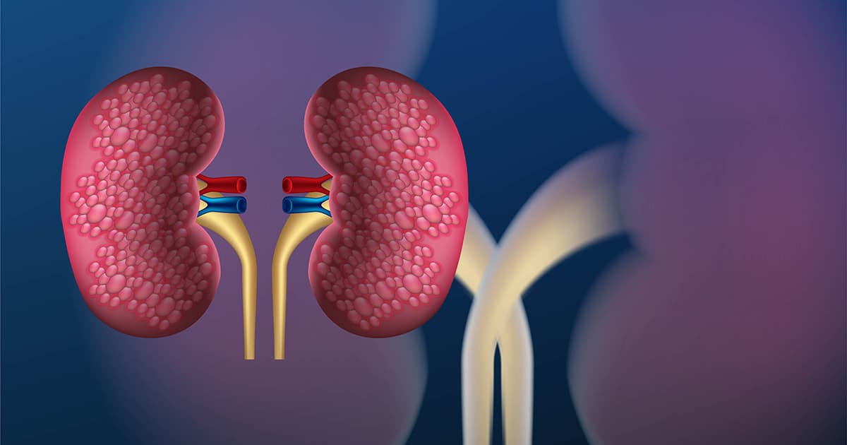 Trombosi venosa renale serve l'anticoagulante?