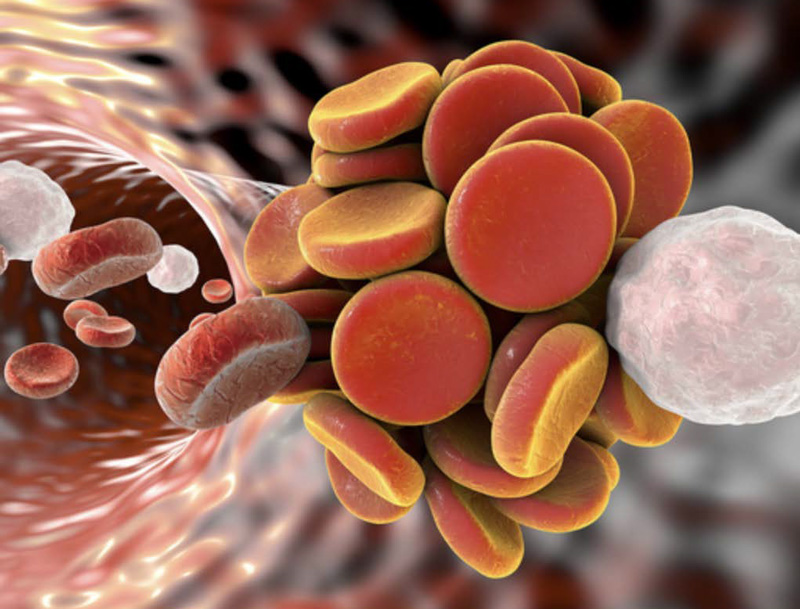 Le complicazioni tromboemboliche venose e arteriose nelle infezioni acute