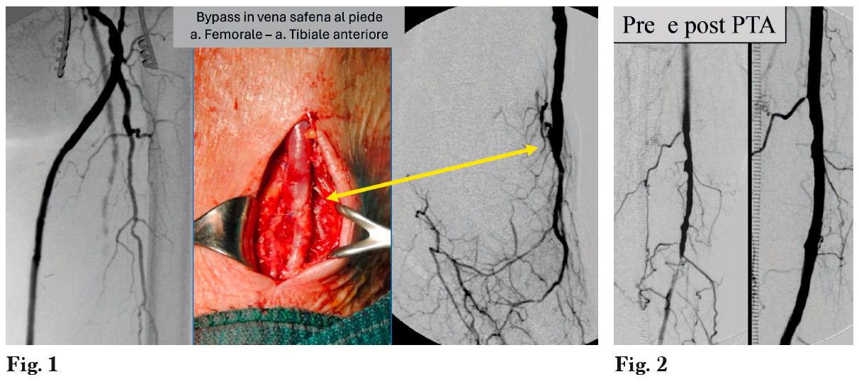 Situazioni di Ischemia Critica